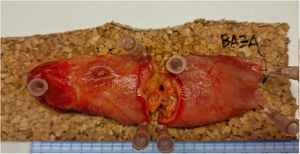 Duodenal lipoma after the resection (piecemeal in 2 pieces).