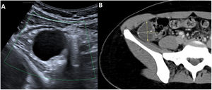 Imagen A: ecografía abdominal que muestra una lesión bien definida y anecogénica lateral al ciego, con paredes finas y sin vascularización en estudio doppler-color. Imagen B: TC con contraste donde se observa una lesión localizada en FID, adyacente al ciego e independiente del apéndice cecal, de paredes bien definidas.