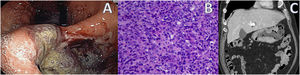 A. Imagen endoscópica. B. Anatomía patológica: cáncer gástrico con estroma linfoide (CMG). Láminas irregulares y trabéculas de células poligonales con infiltrado linfocítico prominente. C. TAC abdominal: engrosamiento parietal en antro gástrico.