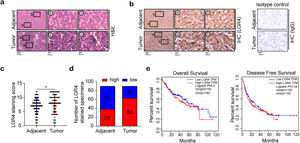 LGR4 is highly expressed in HCC and correlated with the degree of malignancy of HCC. (a) Representative H&E staining of human HCC tissues and adjacent tissues. The rectangular image in the left panel was magnified in the middle and right panels. (b) Representative immunohistochemical staining of LGR4 in human HCC tissues and adjacent tissues. The rectangular image in the left panel was magnified in the middle and right panels. Isotype control: The use of the same species source, same subtype, same dose, and same immunoglobulin and subtype of the primary antibody is used to eliminate background staining resulting from non-specific binding of the antibody to the cell surface. (c) Intensity of LGR4 immunoreactivity. (d) LGR4 immunoreactivity is up-regulated in 63 out of 90 HCC tissues. Data was expressed as mean±SD and analyzed by two-tailed Student