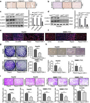 Rspo2-LGR4 exacerbates HCC progression via Wnt/β-catenin signaling pathway. (a) Representative immunohistochemical staining of β-catenin in human HCC tissues and adjacent tissues. The rectangular image in the left panel was magnified in the right panels. (b) Representative images of β-catenin immunohistochemical staining in the liver tissues of each group of mice. (c) Representative Western blotting of LGR4, cyclinD1 and β-catenin in liver tissues from each group of mice. (d) Representative Western blotting of nuclear β-catenin and c-Myc in liver tissues from each group of mice. (e, f) Immunofluorescent images for β-catenin in HepG2 (e) and SMMC-7721 (f) cells treated with si-LGR4, exogenous Rspo2 (100ng/mL) or Rspo2+IWR-1 (10μM). Scale bar: 200μm. (g–i) Plate colony-formation, sphere formation and transwell assays on HepG2 and SMMC-7721 cells treated with exogenous Rspo2 (100ng/mL) or Rspo2+IWR-1 (10μM). Scale bar: 200μm. The lactate concentration in medium in HepG2 cells treated with exogenous Rspo2 (100ng/mL) or Rspo2+IWR-1 (10μM). At least three independently repeated experiments were conducted. Data was expressed as mean±SD and analyzed by two-tailed Student