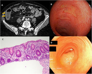 A: notice the right colonic wall thickening. B: Diffuse ileitis with large superficial and ulcers in the terminal ileum. C: Pathological study revealed non-specific features with neutrophilic, eosinophilic and lymphocytic infiltration. D: A second colonoscopy 4 months later showing mucosal healing in the terminal ileum.