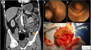 A 61-years-old male attended for 2 weeks of melena. Laboratory assay showed anemia (hemoglobin of 7.1g/dl). Initially, esophagogastroduodenoscopy was performed, without signs of upper gastrointestinal bleeding. Colonoscopy showed a normal colon with blood coming from the terminal ileum, without identifying the origin of the bleeding. With the suspicion of small bowel bleeding, an endoscopic capsule (Pillcam SB 3®, Medtronic, USA) (panels B and C) was ingested, which showed the presence of a polypoid lesion of at least 20mm in a distal segment of the jejunum. A computer tomography enteroclysis (panel A) was performed which showed a small bowel tumor without evidence of dissemination. The case was discussed in a multidisciplinary committee deciding a small bowel resection. Surgical small bowel piece is presented in panel D. The histological study of the surgical piece revealed the presence of a low grade (KI67: 1%), well differentiated neuroendocrine tumor. Patient presented favorable evolution and was discharged without recurrence during the follow up.