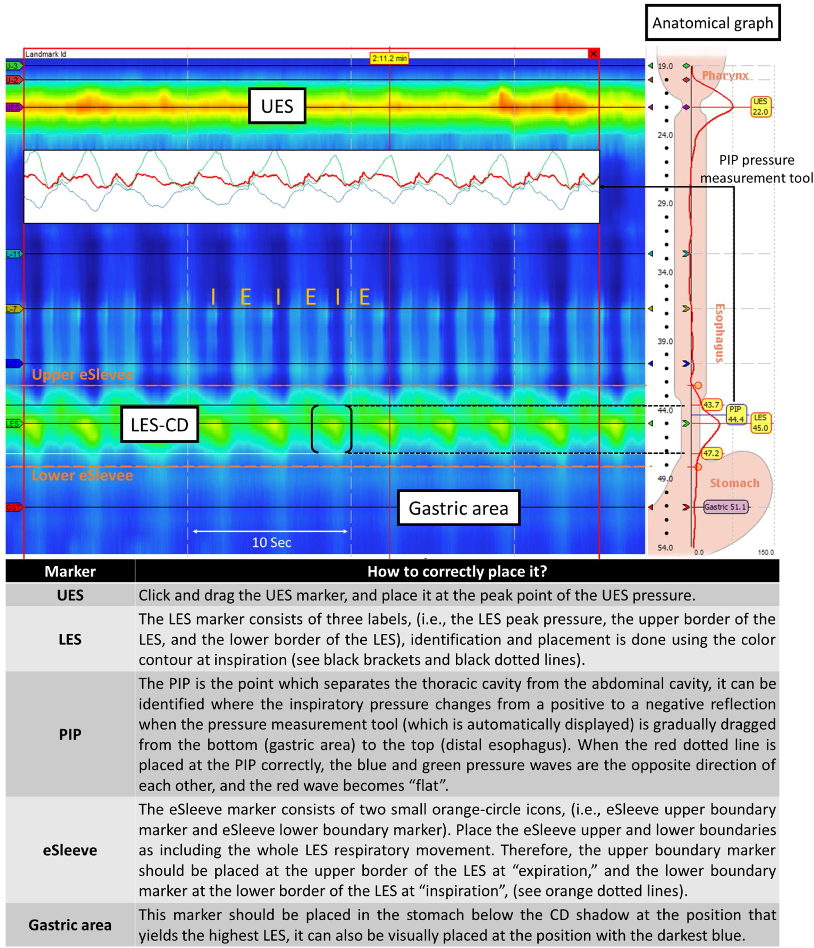 Brief guidelines for beginners on how to perform and analyze esophageal ...