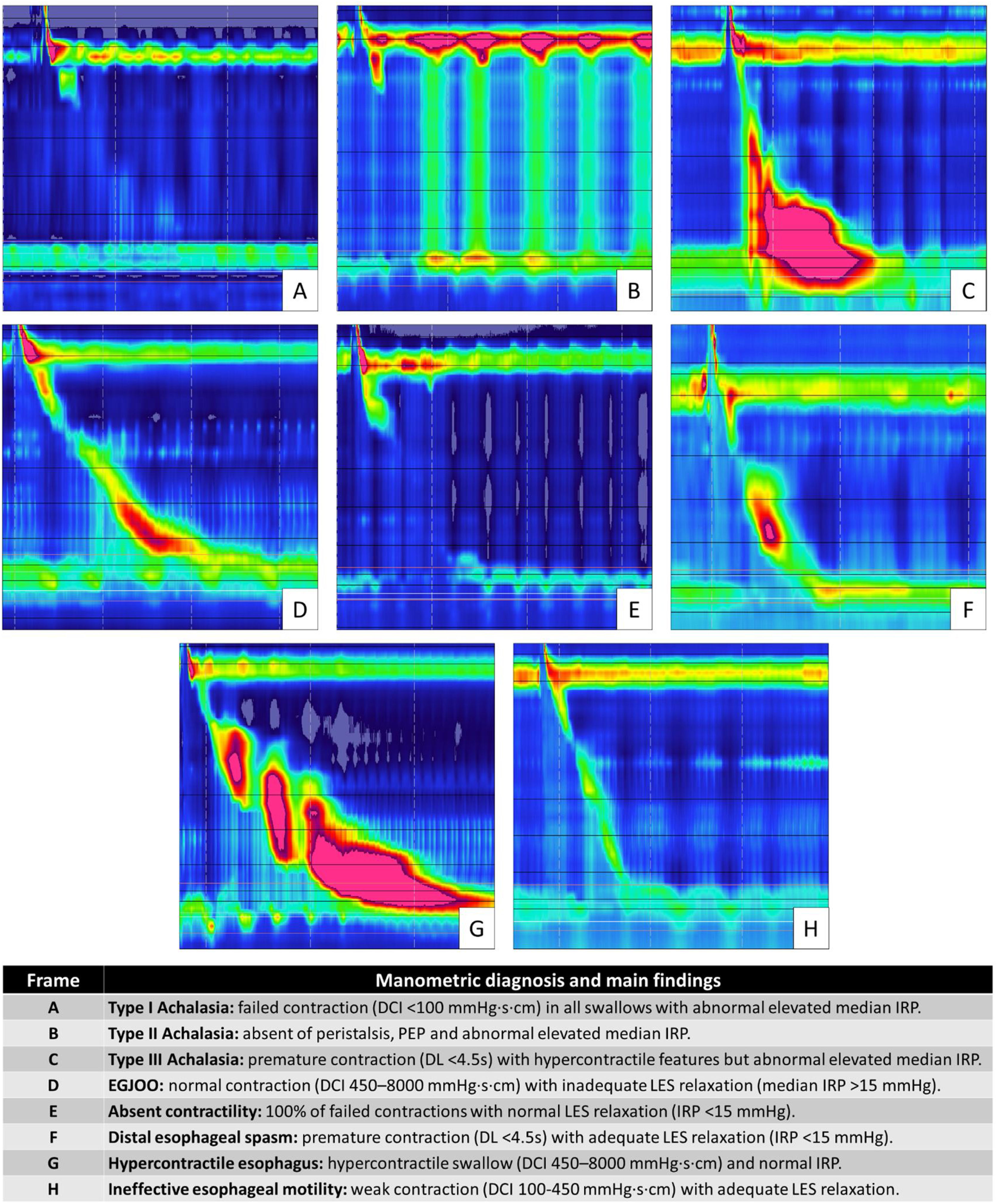 Normal Manometry Reading Brief guidelines for beginners on how to perform and analyze esophageal ...