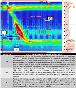 Assessment of main HRM metrics in a normal study. Abbreviations: CDP: contractile deceleration point; DCI: distal contractile integral; DL: distal latency; IRP: integrated relaxation pressure; LES: lower esophageal sphincter; UES: upper esophageal sphincter.