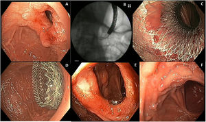 (A) Endoscopic image of duodenal stenosis. (B) Fluoroscopic image of stent deployment. (C and D) Endoscopic images of the stent successfully deployed and placed in duodenal stenosis. (E) Endoscopic image immediately after stent removal. (F) Endoscopic image of the previous site of duodenal stenosis 5 months after stent removal, without inflammation or stenosis.