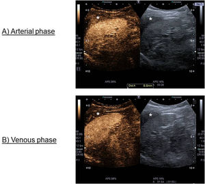 Intravenous contrast (SonoVue®) ultrasound image. (A) Arterial phase: homogeneous filling of the crescent-shaped formation; (B) Late venous phase: washout with respect to the splenic surface of the crescent-shaped formation. *Area of interest.