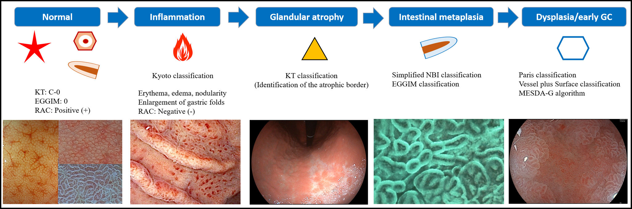 The endoscopic model for gastric carcinogenesis and Helicobacter pylori ...