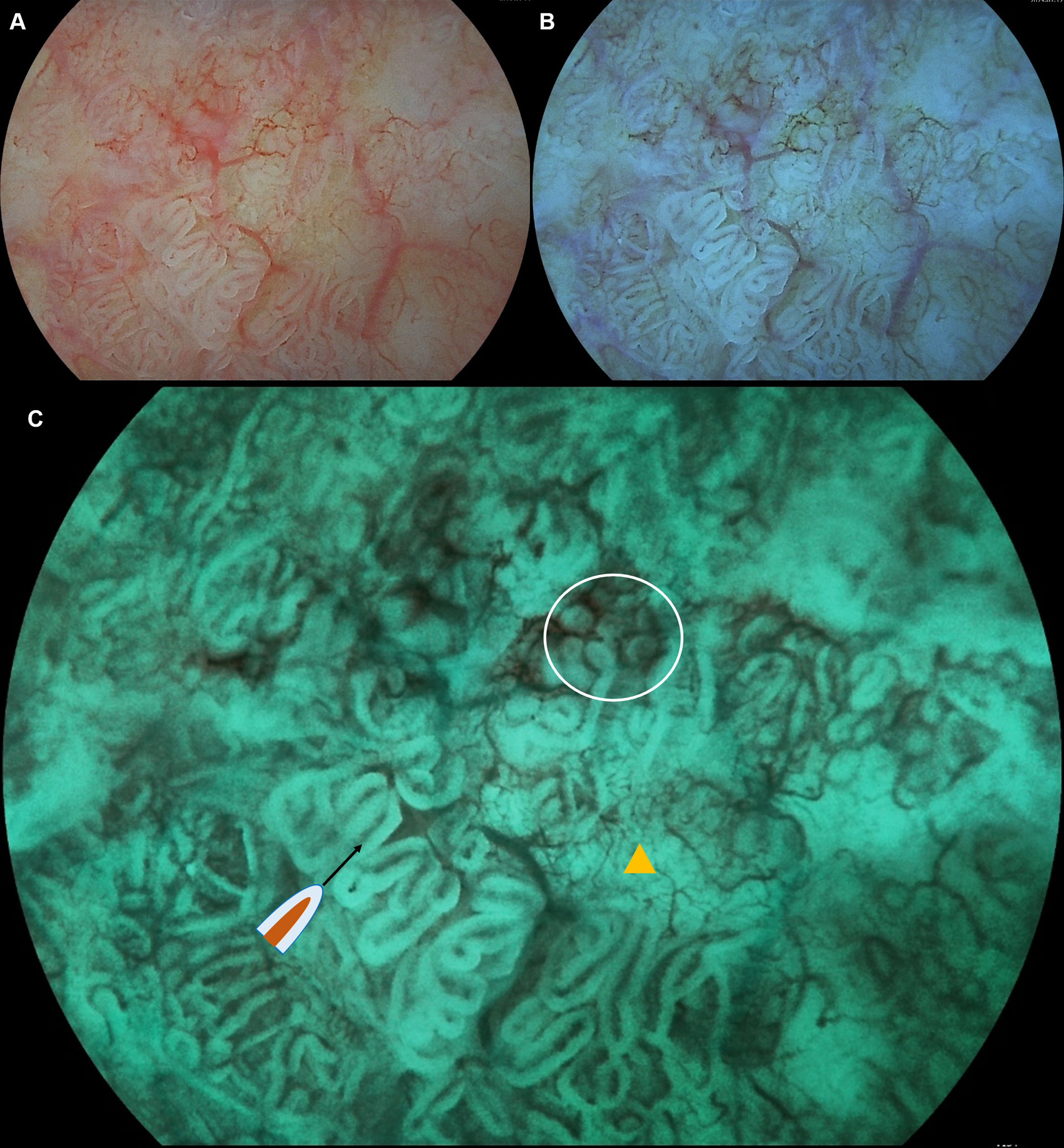 The endoscopic model for gastric carcinogenesis and Helicobacter pylori ...