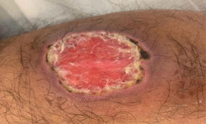 Pioderma gangrenoso.