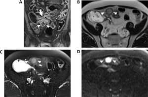 Enterografía por RM de un paciente con enfermedad de Crohn con una colección abdominal asociada a una estenosis ileal. A)Imagen T1 con supresión de la señal grasa en plano coronal tras la inyección de contraste intravenosa. Se puede identificar una colección bien delimitada y con hiperrealce de su pared de 24mm (puntas de flecha) asociada a una estenosis con signos inflamatorios (flecha). B,C)Imagen T2 en plano axial sin (B) y con (C) supresión de la señal de la grasa donde se puede identificar la colección (puntas de flecha) cuyo contenido muestra características líquidas, aunque de menor señal que el contraste oral del intestino. D)Imagen en difusión en el plano axial que muestra la colección que presenta una alta intensidad de señal (puntas de flecha) debido a la marcada restricción de la difusión característica de las colecciones.