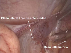 Imagen por laparoscopia para el tratamiento de un paciente con EC ileocecal fistulizante, donde se puede apreciar que el plano lateral o anti-mesentérico se encuentra respetado, por lo que resulta de utilidad utilizar esta vía para la movilización del segmento afectado.