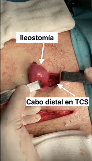 Imagen ilustrando la confección de una ileostomía en un paciente operado por EC fistulizante en el cual el cabo distal de colon se aboca al tejido celular subcutáneo, previniendo complicaciones si este se abre durante el postoperatorio, y a su vez facilitando la posterior cirugía de reconstrucción del tránsito intestinal en un segundo tiempo.