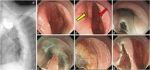 Esophagram and standard Z-POEM. (a) Large Zenker