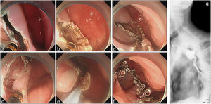Modified Z-POEM. (a) Bilateral mucosotomy; (b) full-thickness septotomy extending to the diverticular base; (c) irregular mucosal margin with >1mm serration; (d) precise incision of protruded septal remnants using incision knife; (e) resection with snare; (f) complete mucosal closure using clips; (g) postoperative day-7 esophagram confirming diverticular resolution and absence of contrast extravasation.