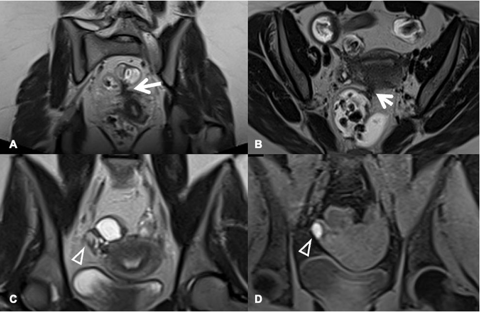 Bile acid malabsorption diarrhea as a clinical manifestation of ...