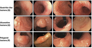 Morphology of early gastric cancer based on the GUP system proposed by Yao et al.58,59 Gastritis-like lesions (G): Superficial lesions resembling erosive or atrophic gastritis (Paris 0–IIa, IIb, IIc). Lesions are subtle, with slight surface or color changes. Key markers include localized changes in mucosal texture, color demarcation, and abrupt interruption of the background vascular pattern. Ulcerative lesions (U): Lesions with a depressed or ulcerated appearance (Paris 0–III) resembling peptic ulcers. Features include surface changes and shallow ulceration. Polypoid lesions (P): Elevated lesions resembling polyps (Paris 0–I). Lesions show focal protrusion above the surrounding mucosa, often with distinct color or surface abnormalities. Images were kindly provided by Dr. Andrés Donoso.