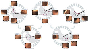 Systematic and sequential gastric examination using high-definition white light endoscopy (HD-WLE).