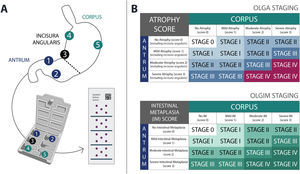 Updated Sydney system for collecting gastric biopsies (A) and Operative Link on Gastritis Assessment (OLGA) and Operative Link on Gastric Intestinal Metaplasia Assessment (OLGIM) histopathological grading systems for gastric cancer risk (B).