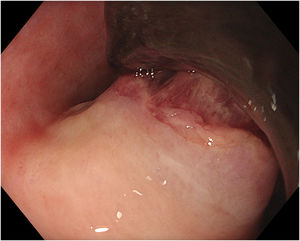 Imagen de endoscopia digestiva alta: lesión sobreelevada en esófago medio (a 25cm de arcada dentaria) de superficie lisa y coloración violácea, con coágulo adherido en su polo superior, sin evidencia de sangrado activo.