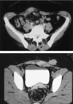 Tomografía computarizada abdominal que muestra imágenes de endometriomas de pared abdominal con su espiculación característica.
