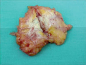 Visión macroscópica de pieza de resección quirúrgica (endometrioma de pared abdominal sobre cicatriz de Pfannenstiel).