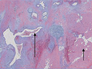 Visión anatomopatológica de endometrioma umbilical que muestra características de lesión endometriósica activa (flecha negra) con actividad mitósica elevada y presencia de hemosiderófagos.