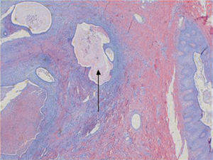 Visión microscópica de endometriosis (endometrioma de recto anterior del abdomen) que muestra glándulas endometriales (flecha negra) y estroma junto con fibras de musculatura estriada (HE, ×400).