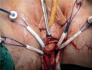 Colocación de la malla Prolift® anterior con aplicadores del kit.