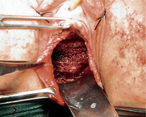 Malla de polipropileno Prolift® anterior colocada.