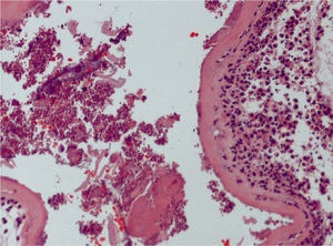 Imagen histológica de la placenta que muestra signos de coriamnionitis y formas levaduriformes.