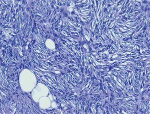 Patrón arremolinado de células fusiformes con cromatina blanda, sin atipias ni mitosis. Presencia de algunos adipocitos atrapados (HE, × 20).