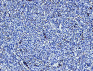 Positividad para vimentina en las células tumorales (tinción inmunohistoquímica para vimentina, ×20).