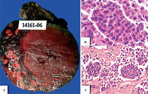 Tumor de ovario en una paciente de 23 años. Imagen macroscópica (A) y microscópica del tumor (B y C). Las células tumorales se encuentran formando trabéculas y/o cordones, presentan un patrón homogéneo y se encuentran separadas por escaso estroma. Esta imagen indica la presencia de disgerminoma.