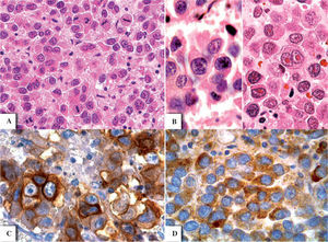 Disgerminoma «anaplásico». Se observan abundantes mitosis y estroma intercelular compuesto por escasos linfocitos y fibras colágenas (A). Las células neoplásicas presentan abundante citoplasma eosinófilo con patrón «plasmocitoide» (B, izquierda), así como pleomorfismo, núcleos irregulares y células binucleadas con nucléolos eosinófilos prominentes (B, derecha). La inmunohistoquímica para CD117 fue multifocal y mostró expresión membranal en las células tumorales (C), mientras que la expresión de PLAP (placental-like alkaline phosphatase) fue citoplásmica difusa, con un patrón granular (D).