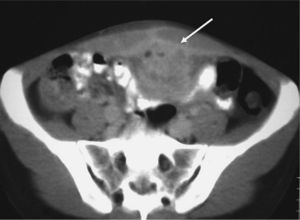 Tomografía computarizada de abdomen con contraste en la que se aprecia masa pélvica que pierde plano de separación con músculo recto abdominal izquierdo y con asas de intestino delgado.