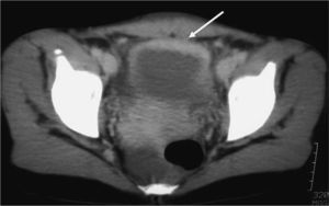 Tomografía computarizada de abdomen con contraste en la que se aprecia engrosamiento de la pared vesical anterior y pequeña cantidad de líquido libre en fondo de saco de Douglas.