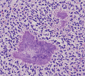 La anatomía patológica estableció el diagnóstico, poniendo de manifiesto una reacción inflamatoria de tipo crónico, con áreas necróticoexudativas entre las que se encontraban colonias de Actinomyces.