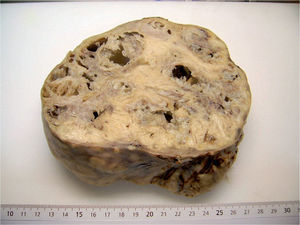 Mioma uterino gigante.