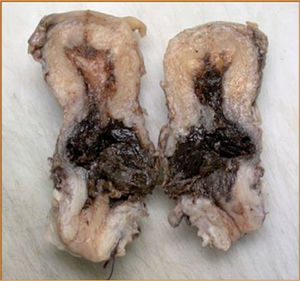 Pieza de histerectomía. Infiltración hemorrágica en la zona ístmica cervical.