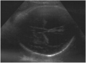 Hidrocefalia bilateral severa.