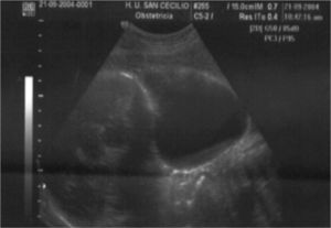 Tumoración retrocervical.