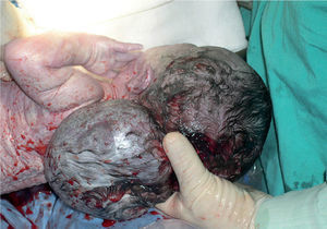 Tumoración retrocervical.