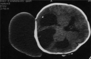 Comunicación tumoración-fosa posterior.