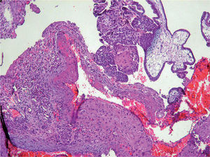 Corte microscópico que muestra la presencia de tejido trofoblástico en el parénquima ovárico.