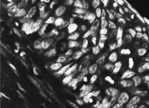 Microscopía electrónica. Carcinoma in situ escamoso en el endometrio.