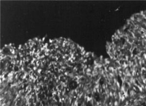 Microscopia electrónica. Afectación vaginal de carcinoma in situ escamoso.