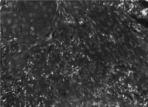 Microscopia electrónica. Carcinoma microinvasivo de cérvix.