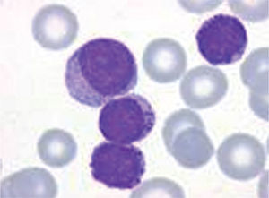 Leucemia linfoide crónica B. Las células linfoides muestran una marcada desgranulación.